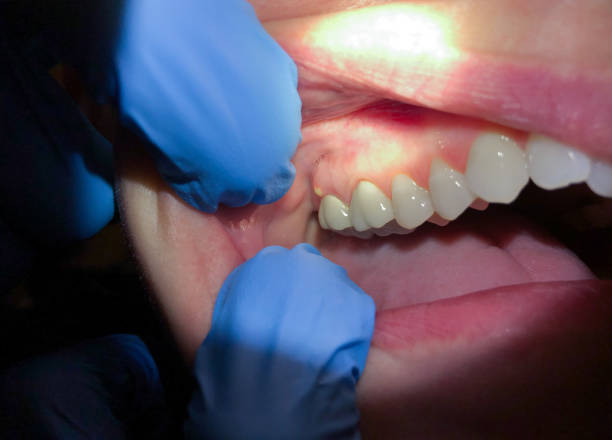 Best Root Canal Emergency Dentist  in Ridge Manor, FL